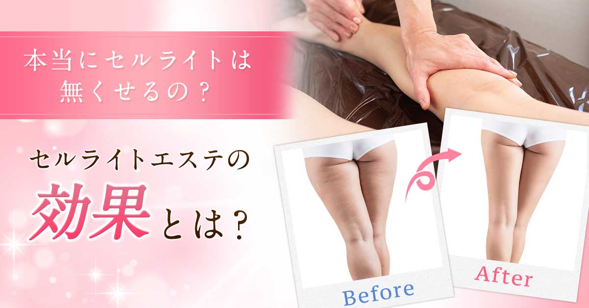 セルライトエステをなくす効果を徹底検証